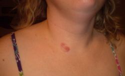 Что приносит родинка на шее?