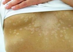 Белые пятна на коже ног и спины: причины, и как избавиться