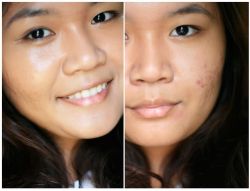 Лечим шрамы от прыщей