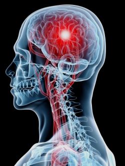 Геморрагический инсульт - что это, какие могут быть последствия 