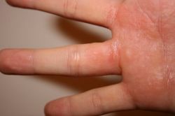 Дисгидроз кистей рук и его последствия