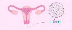 Что такое инсеминация? Как проходит процедура? Методы искусственного оплодотворения