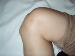 Факты медицины: болезнь Шляттера