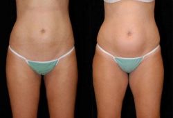 Советы, как сделать плоский живот