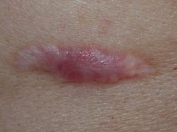 Коллоидные рубцы: причины образования и методы лечения 