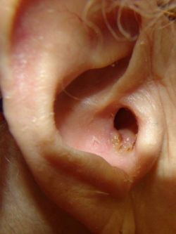 Фурункул в ухе: симптомы, причины появления, лечение