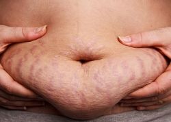 Как избавиться от растяжек в домашних условиях: советы и рекомендации