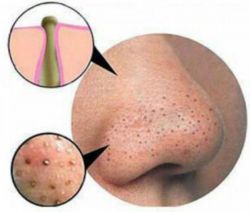 Средство от черных точек на лице: обзор эффективных препаратов, маски, кремы. Как избавиться от черных точек на лице