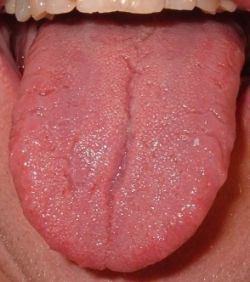 Рак языка: симптомы и лечение