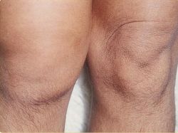 Синовит коленного сустава: симптомы и лечение