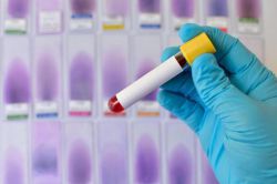 Анализ на иммуноглобулины: норма, расшифровка