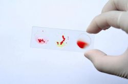 Агглютинация крови - это склеивание и оседание в виде осадка эритроцитов, бактерий и других клеток, которые несут антигены