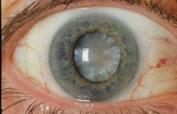 Последствия сахарного диабета: чем опасен, можно ли умереть