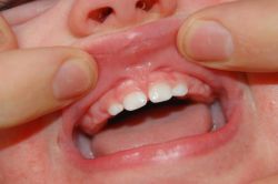 Стоматологический гель 