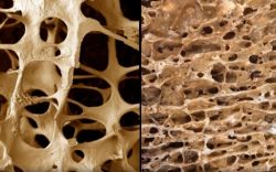 Симптомы остеопороза и профилактика данного заболевания