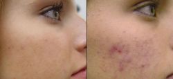 Болтушка от прыщей. Чудесное и недорогое средство 