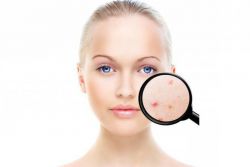 Что такое угри? Причины и лечение угревой сыпи