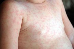 Герпес 6 типа - что это такое?