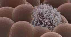 Саркома Капоши: что это такое, симптомы, лечение, прогноз