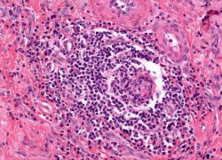 Саркоидоз: что такое, причины, симптомы, лечение