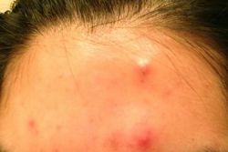 Как за ночь избавится от прыща в домашних условиях?