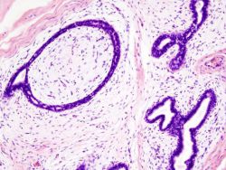 Диффузный фиброаденоматоз молочных желез - что это такое? Симптомы, чем лечить