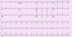 НБПНПГ на ЭКГ - что это? Неполная блокада правой ножки пучка Гиса - причины, симптомы и лечение