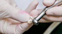 Имплант или мост: что лучше? Плюсы и минусы