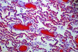 Что такое гиперемия? Виды, признаки и лечение