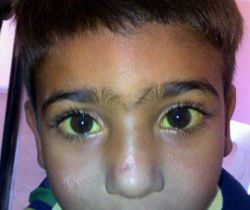 Гипербилирубинемия - что это такое? Диагностика, причины синдрома