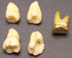 Когда растут зубы мудрости - возраст, симптомы и особенности процесса