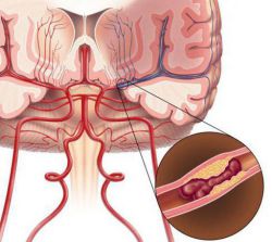 Что такое ишемия? Виды, причины, симптомы, лечение и последствия ишемии