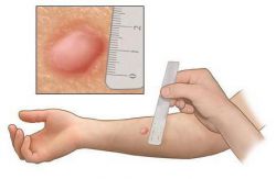 Оценка результата пробы Манту у взрослых и детей