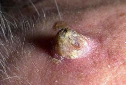 Кератопапиллома - что это такое? Удаление кератопапилломы