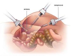 Что такое лапароскопия в гинекологии: показания, подготовка и последствия