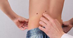 Когда появляются родинки у детей и какие их виды бывают?