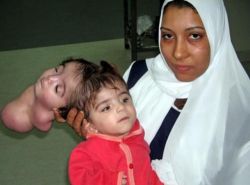 Как выглядят и почему появляются паразитарные краниопаги?