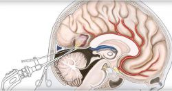 Ретроцеребеллярная арахноидальная киста головного мозга: чем опасна, причины возникновения, симптомы и методы лечения