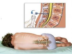 Что такое пункция? Показания к назначению и последствия пункции