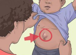 Околопупочная, или параумбиликальная грыжа: причины, симптомы и лечение