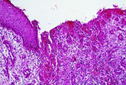 Сифилитический шанкр: особенности заболевания