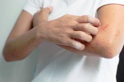 Опоясывающий лишай заразен или нет для человека?