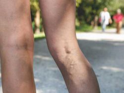 Что лечит ангиохирург, с какими симптомами обращаться?