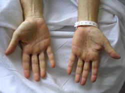 Инкубационный период сифилиса: как проявляется, особенности и лечение