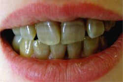 Почернели зубы: причины, что делать