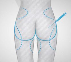 Липофилинг ягодиц: отзывы пациентов и этапы