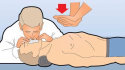 Оказание первой помощи при остановке дыхания