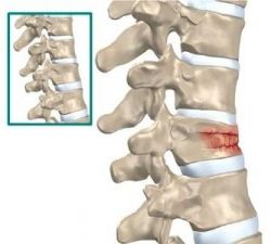 Компрессионный перелом позвоночника: причины, симптомы, лечение