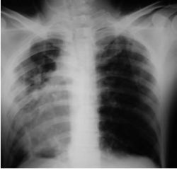 Туберкулез легких: симптомы и лечение 