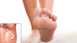 Бородавка на ступне: причины появления и методы лечения. Подошвенная бородавка
